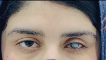 Close-up of a woman's face, showing one healthy eye and one eye with a severe cloudy white cataract.