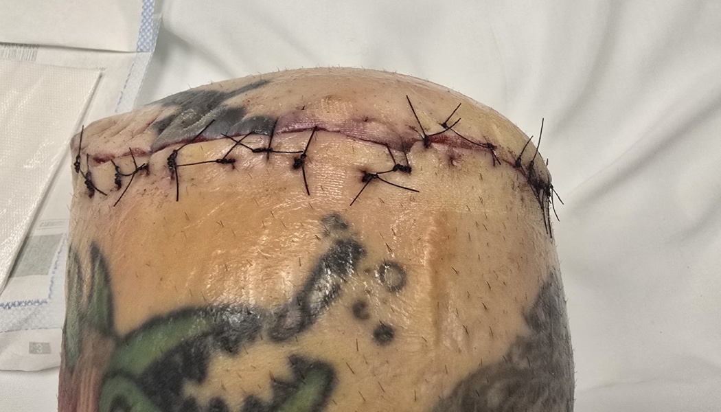 A tattooed residual limb with dark surgical stitches along a fresh amputation incision.