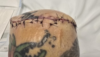 A tattooed residual limb with dark surgical stitches along a fresh amputation incision.