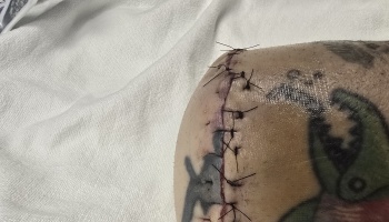 Surgical stitches along a healing incision on a tattooed limb, resting on a white hospital sheet.