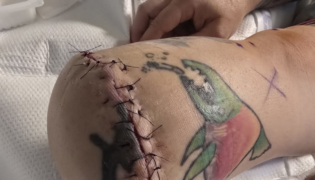 Fresh surgical incision closed with dark stitches on a tattooed limb resting on medical padding.