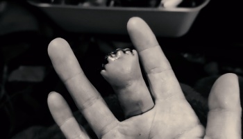 An open hand showing a partially amputated middle finger with surgical stitches at the tip.