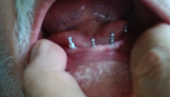 Close-up of an open mouth showing four metal dental implant posts embedded in the lower gums.