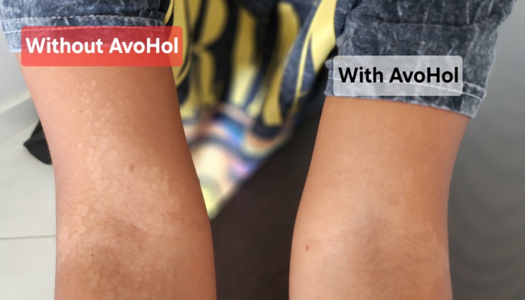 Side-by-side skin comparison showing bumpy rash labeled "Without AvoHol" and clear skin labeled "With AvoHol".