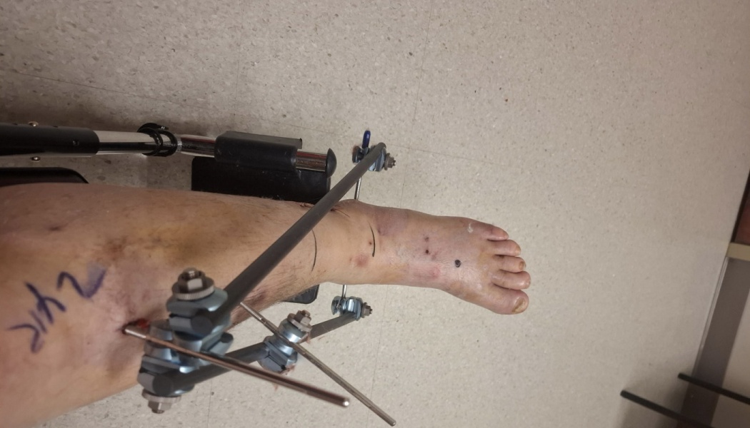 A person's injured lower leg and foot stabilized with a metal external fixator frame.