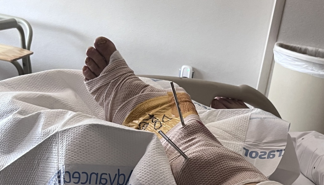 A bandaged leg and foot resting in a hospital bed, with surgical metal pins protruding from the ankle.