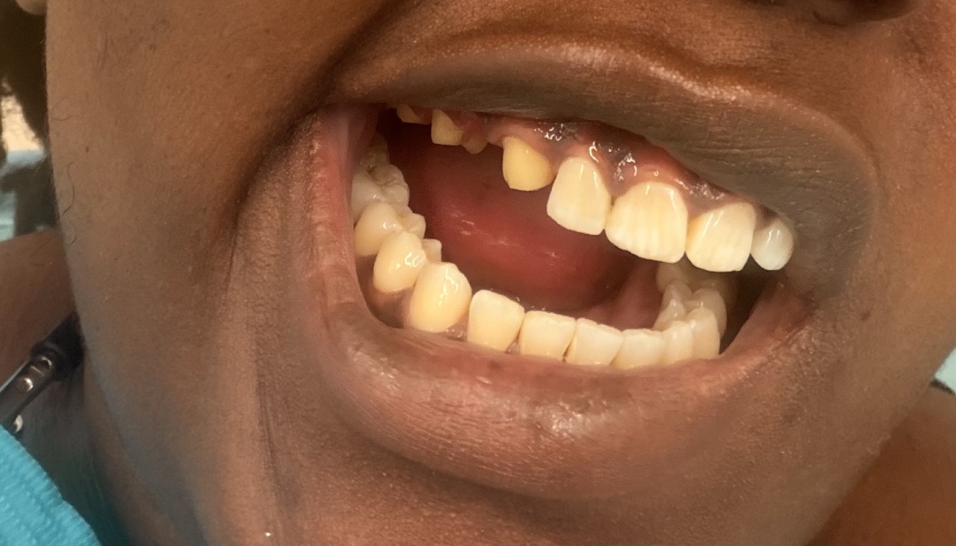 Close-up of a person's open mouth showing missing upper teeth.