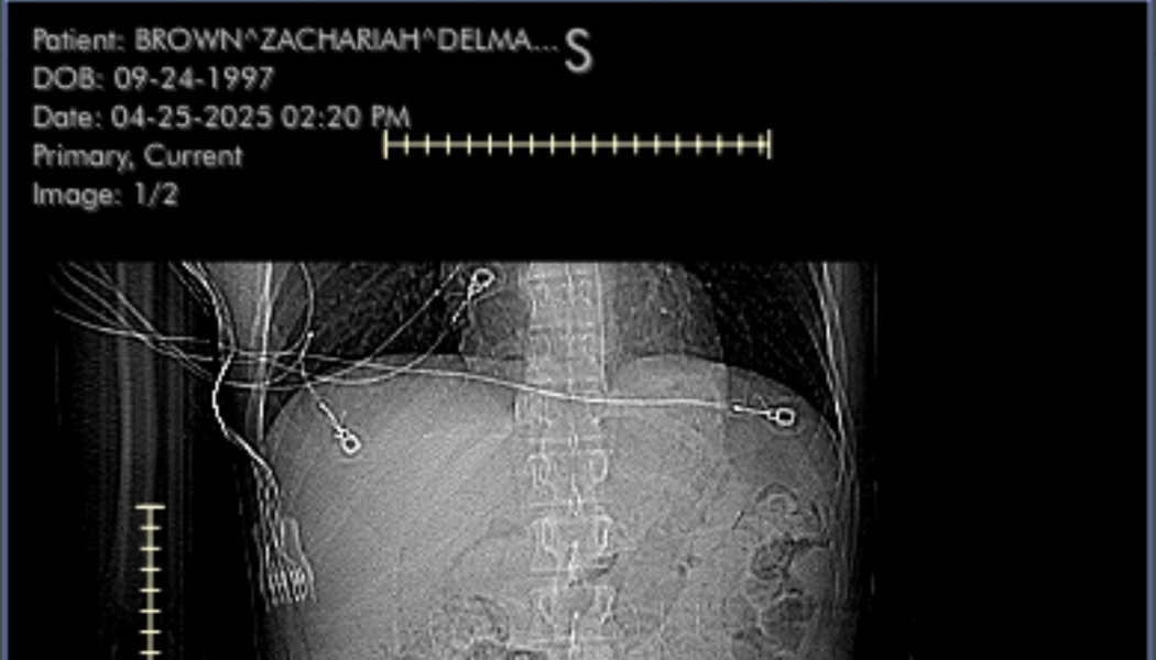 Medical X-ray scan of a patient's torso showing the spine, ribs, and attached monitoring leads.