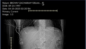 Medical X-ray scan of a patient's torso showing the spine, ribs, and attached monitoring leads.
