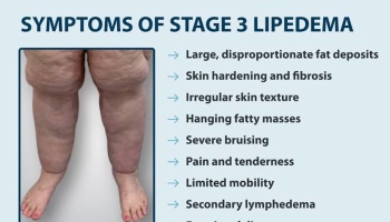 Infographic titled "Symptoms of Stage 3 Lipedema" showing affected legs alongside a list of symptoms.