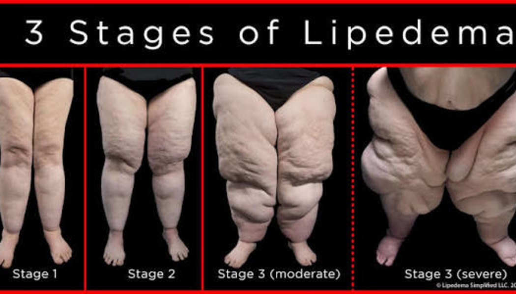 Diagram titled "3 Stages of Lipedema" showing the visual progression of leg swelling from Stage 1 to Stage 3 severe.