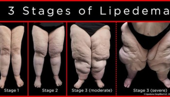 Diagram titled "3 Stages of Lipedema" showing the visual progression of leg swelling from Stage 1 to Stage 3 severe.