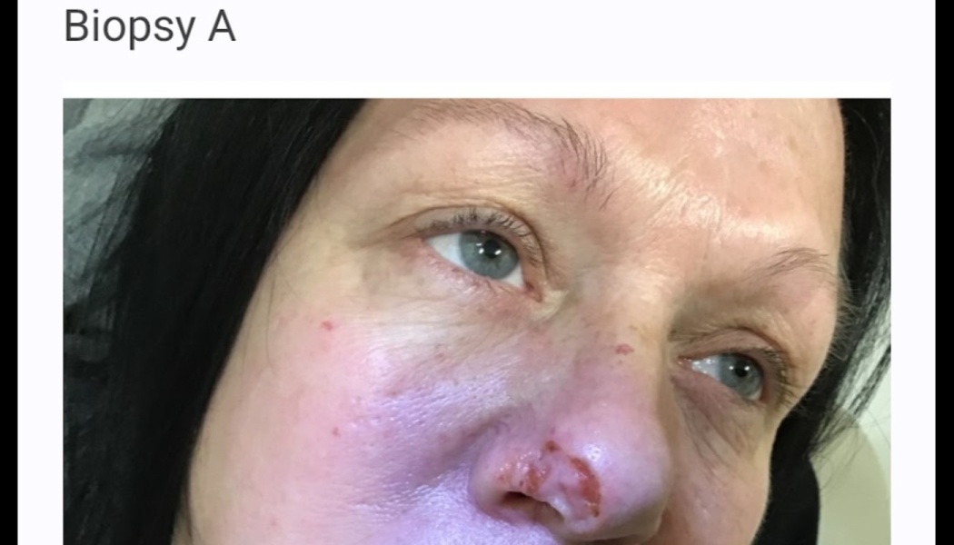 Close-up of a woman's face with a red lesion on the tip of her nose, labeled "Biopsy A."