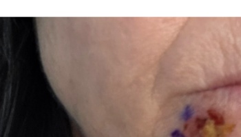 Close-up of a person's lower face showing a small, crusted skin lesion marked with purple surgical ink.
