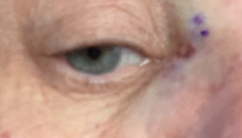 Close-up of a person's eye with purple surgical ink markings and slight bruising near the outer corner.