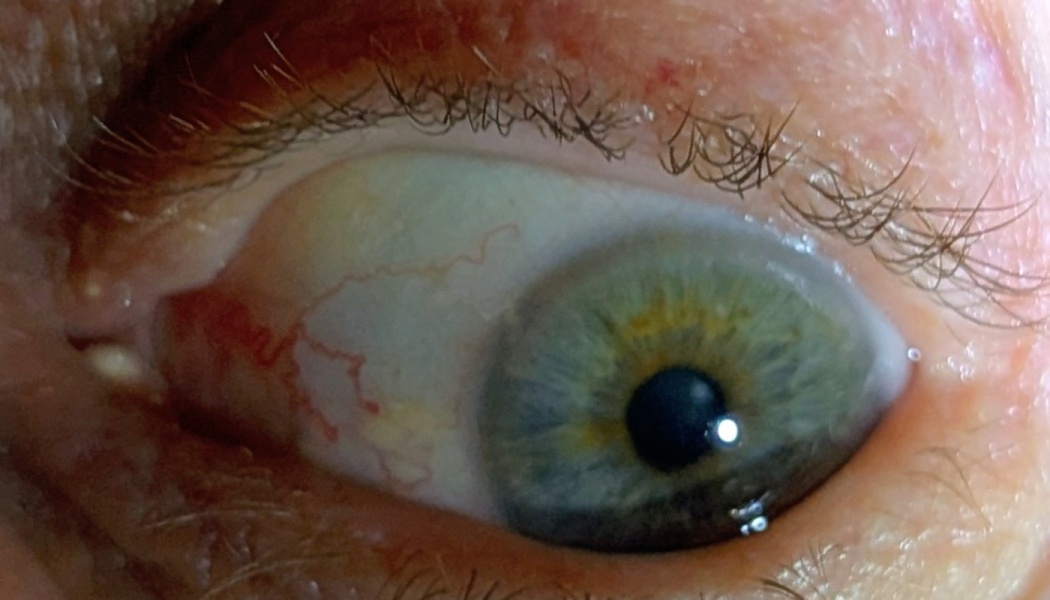 Extreme close-up of a green and hazel eye with red blood vessels visible in the white sclera.