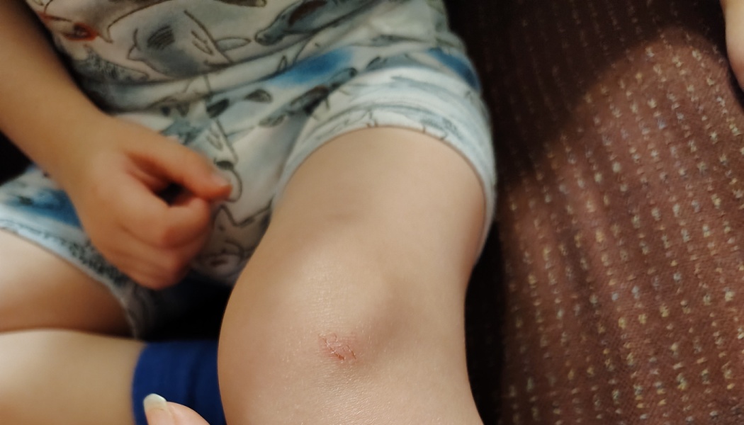 Close-up of a child's knee showing a small red scratch.