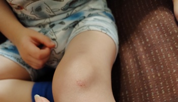 Close-up of a child's knee showing a small red scratch.
