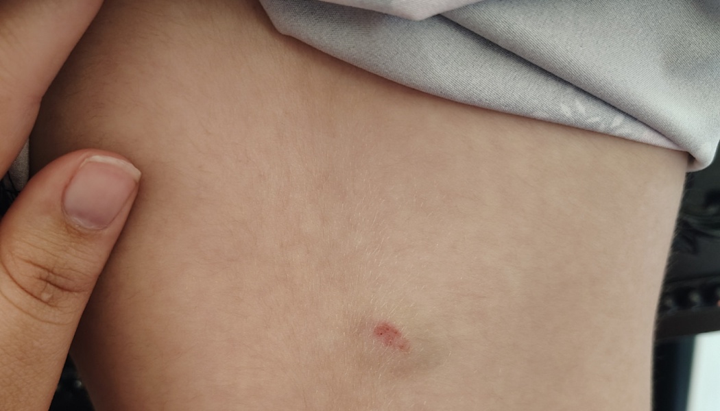 Close-up of a small red mark and faint bruise on fair skin, with a thumb holding fabric aside.