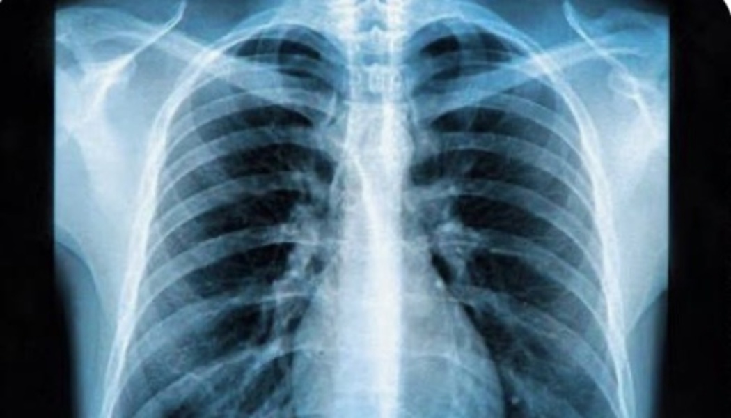 Medical chest X-ray showing a human rib cage, spine, and lungs in blue tones.