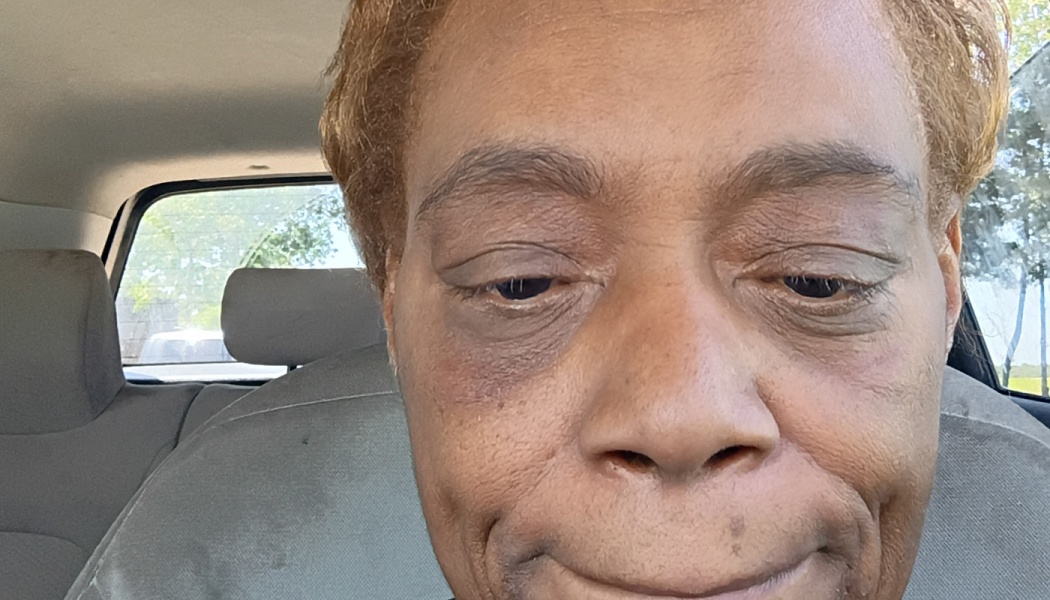 Close-up selfie of a woman inside a car, showing dark bruising under her right eye.