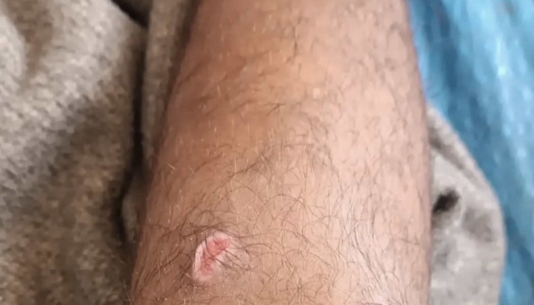 Close-up of a small, raised reddish wound or scar on a hairy leg.