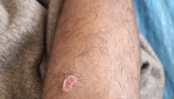 Close-up of a small, raised reddish wound or scar on a hairy leg.