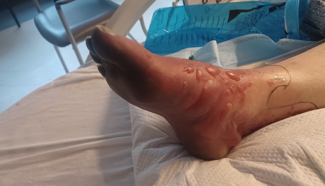 Severely swollen, red foot and ankle with numerous large fluid-filled blisters resting on a hospital pillow.