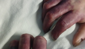 Close-up of severely bruised and dark purple hands resting on a white sheet.