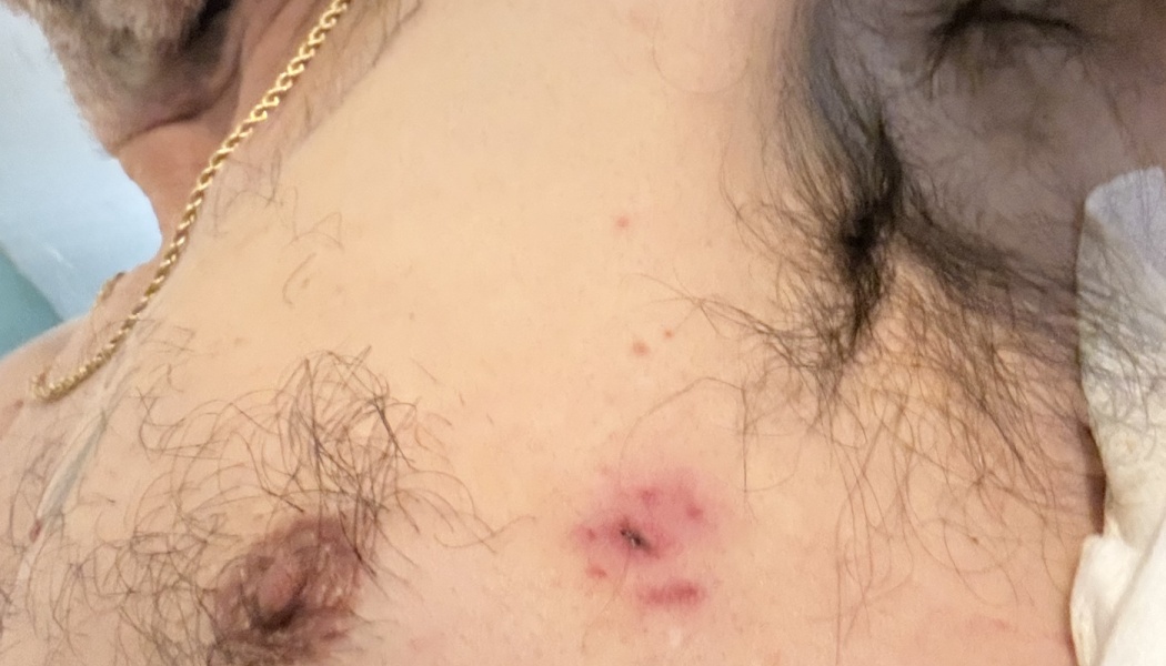 Close-up of a person's upper chest featuring a red, inflamed lesion with a small dark central mark.
