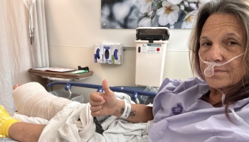 A woman lying in a hospital bed with a nasal cannula and a heavily bandaged leg gives a thumbs-up.