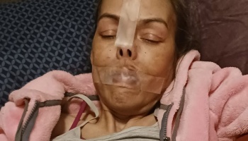 Woman resting in bed with medical tape across her nose and mouth, wearing a pink fleece jacket.