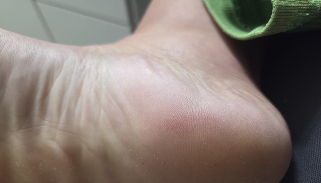 Close-up of the underside of a bare human foot, showing the heel and arch.