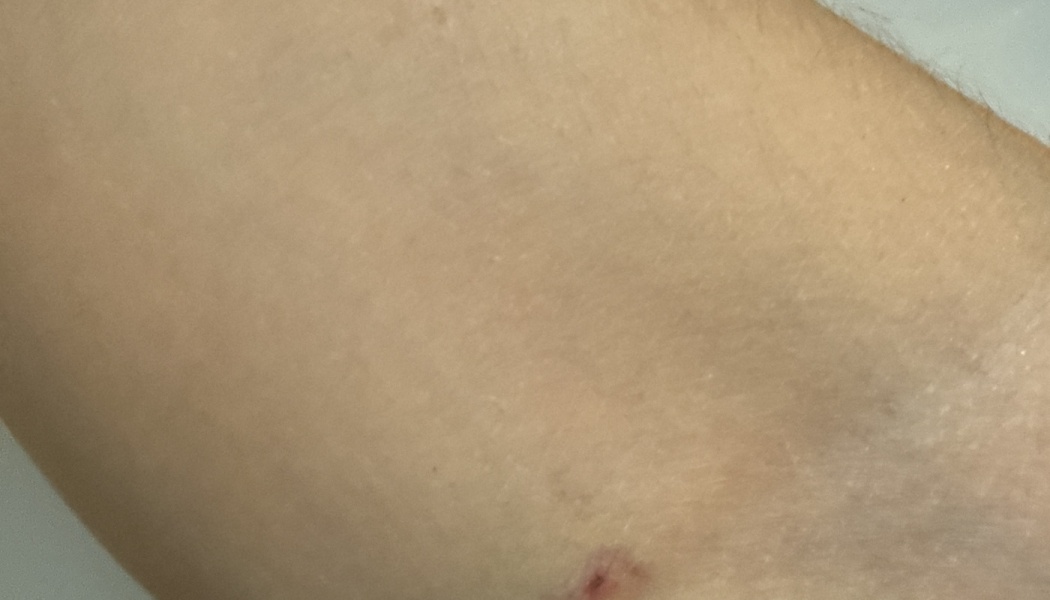 Extreme close-up of fair human skin with a small red scab or puncture mark near the bottom edge.