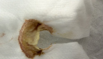 White medical gauze pad with a circular hole, stained with brown and yellow fluid around the opening.
