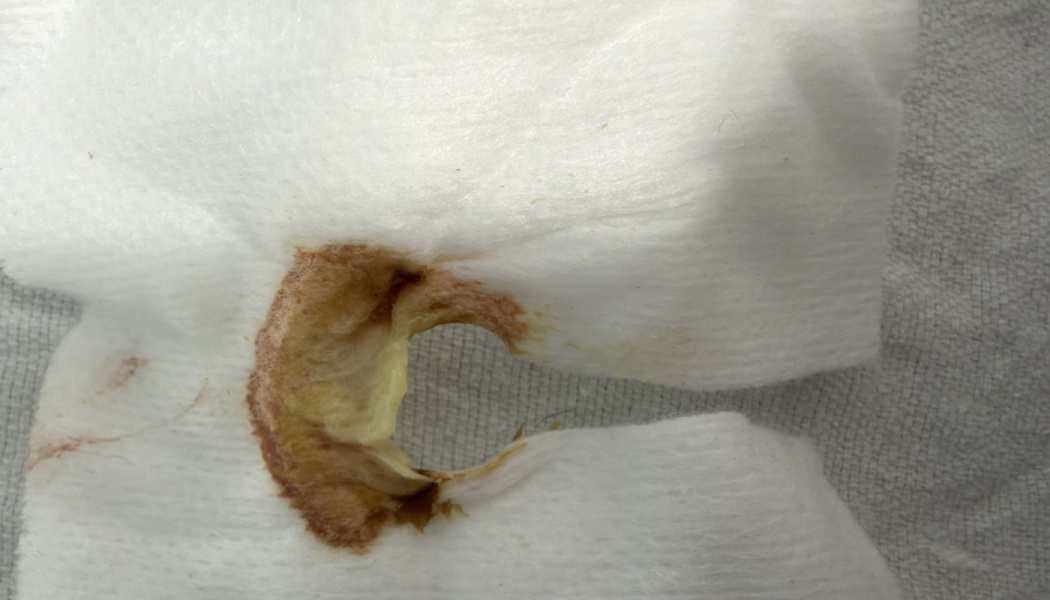 White medical gauze dressing with a cutout opening, stained with yellowish-brown drainage.