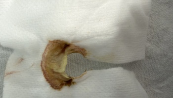White medical gauze dressing with a cutout opening, stained with yellowish-brown drainage.
