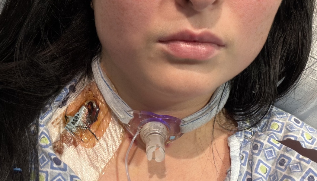 Close-up of a person in a hospital gown with a tracheostomy tube in their neck and a bandage on their upper chest.