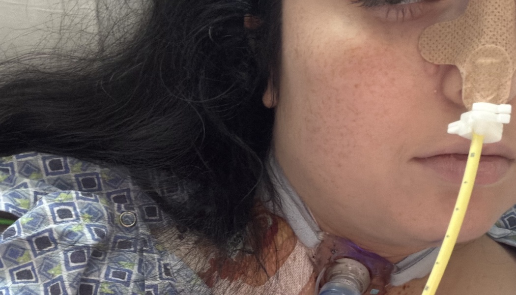 Close-up of a dark-haired woman in a hospital gown with a nasal feeding tube and a tracheostomy tube in her neck.
