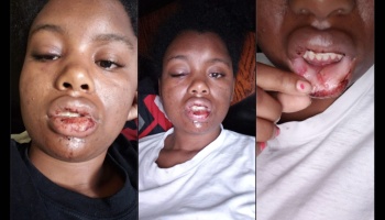 Three photos showing a woman with severe facial injuries, including swollen eyes and cut, bloody lips.