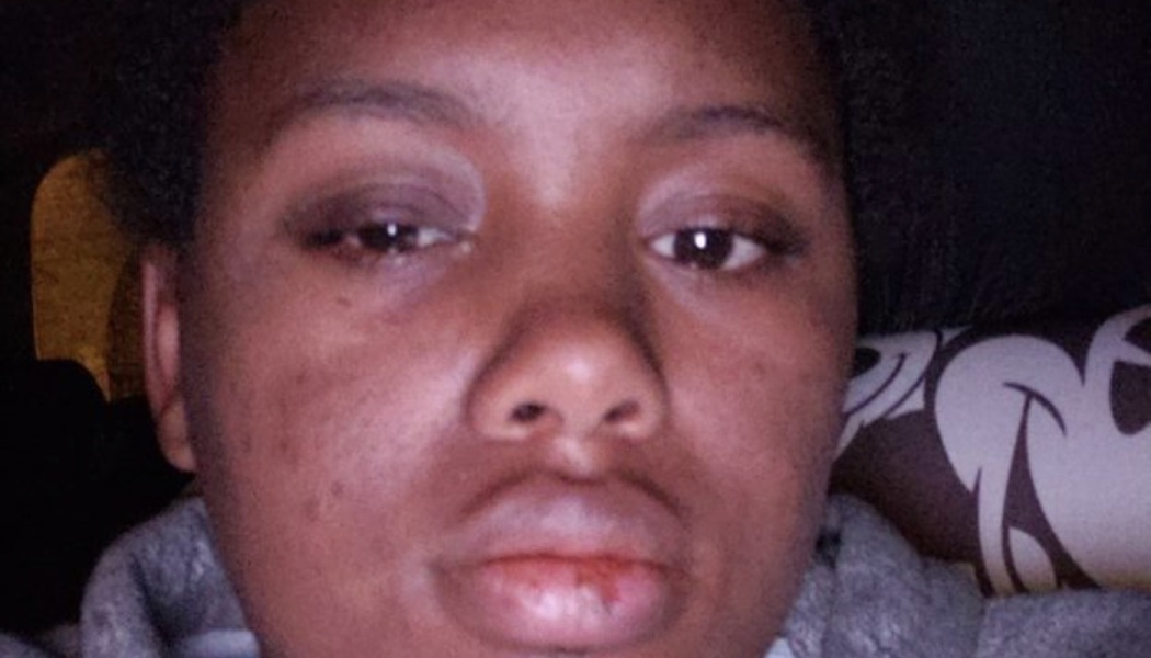 Close-up of a person with facial injuries, including a swollen right eye and a cut on their lower lip.