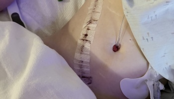 Surgical incision covered with steri-strips and a medical drain tube on a patient's abdomen.