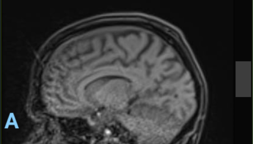 Sagittal MRI scan of a human head displaying internal brain structures in grayscale.