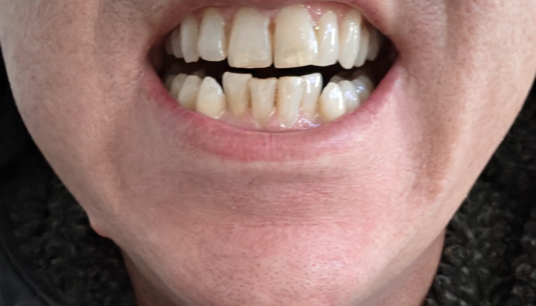 Close-up of a person's open mouth showing crowded, worn, and discolored teeth.