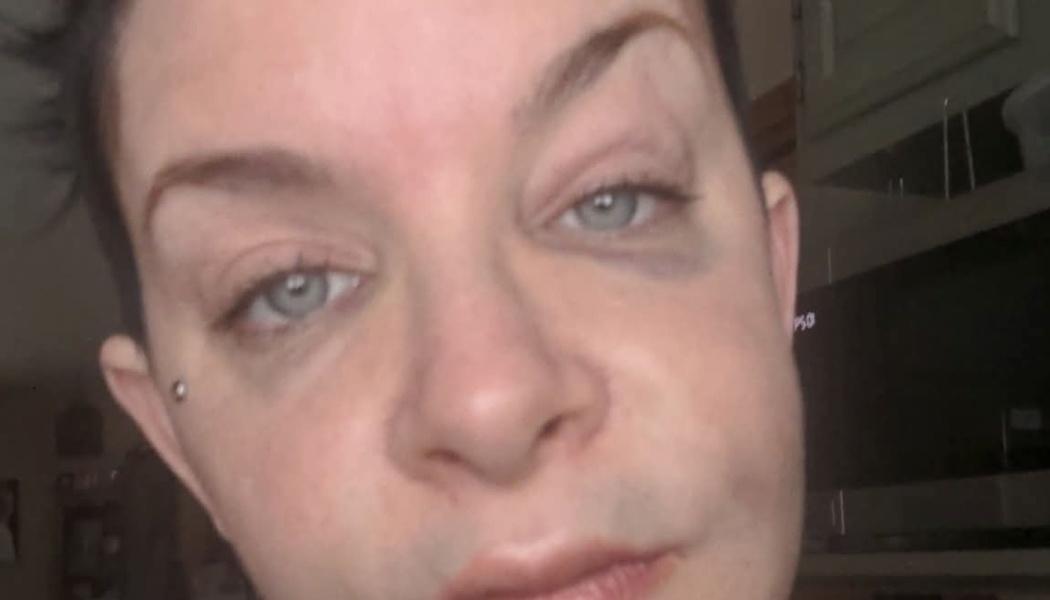 Close-up of a person with light eyes showing visible swelling and bruising around their left eye.