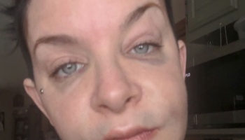 Close-up of a person with light eyes showing visible swelling and bruising around their left eye.