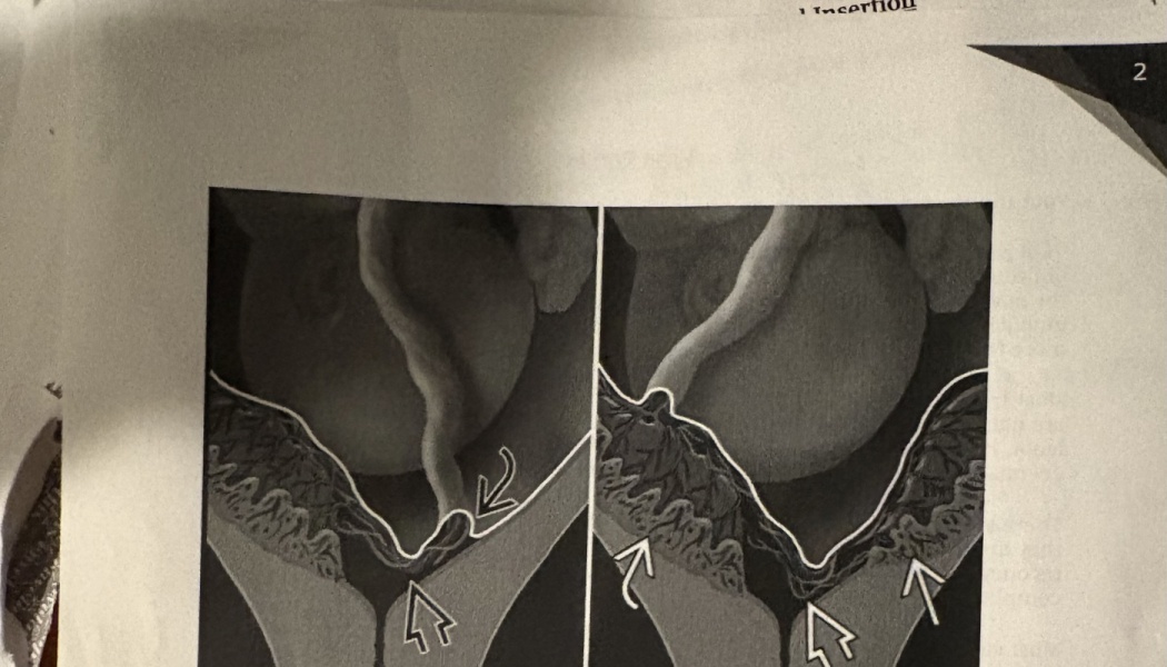Two side-by-side medical diagrams illustrating umbilical cord insertion points, highlighted with white arrows.