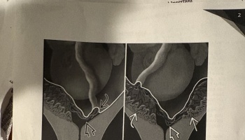 Two side-by-side medical diagrams illustrating umbilical cord insertion points, highlighted with white arrows.