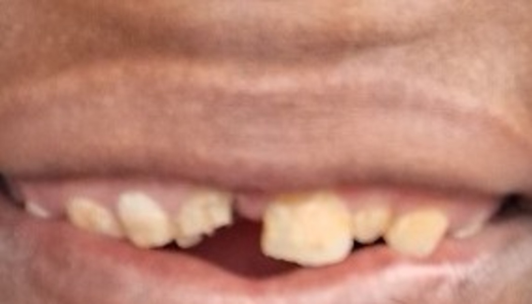 Close-up of a person's mouth showing severely worn, crooked, and discolored upper teeth with visible gaps.