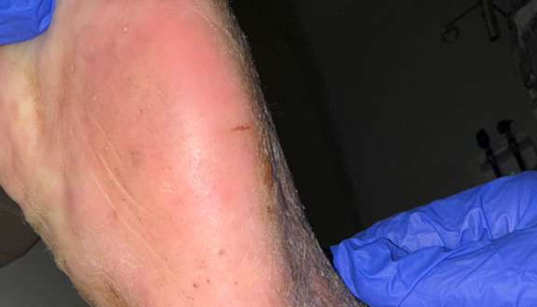 Red, inflamed skin on the sole of a human foot held by hands wearing blue medical gloves.